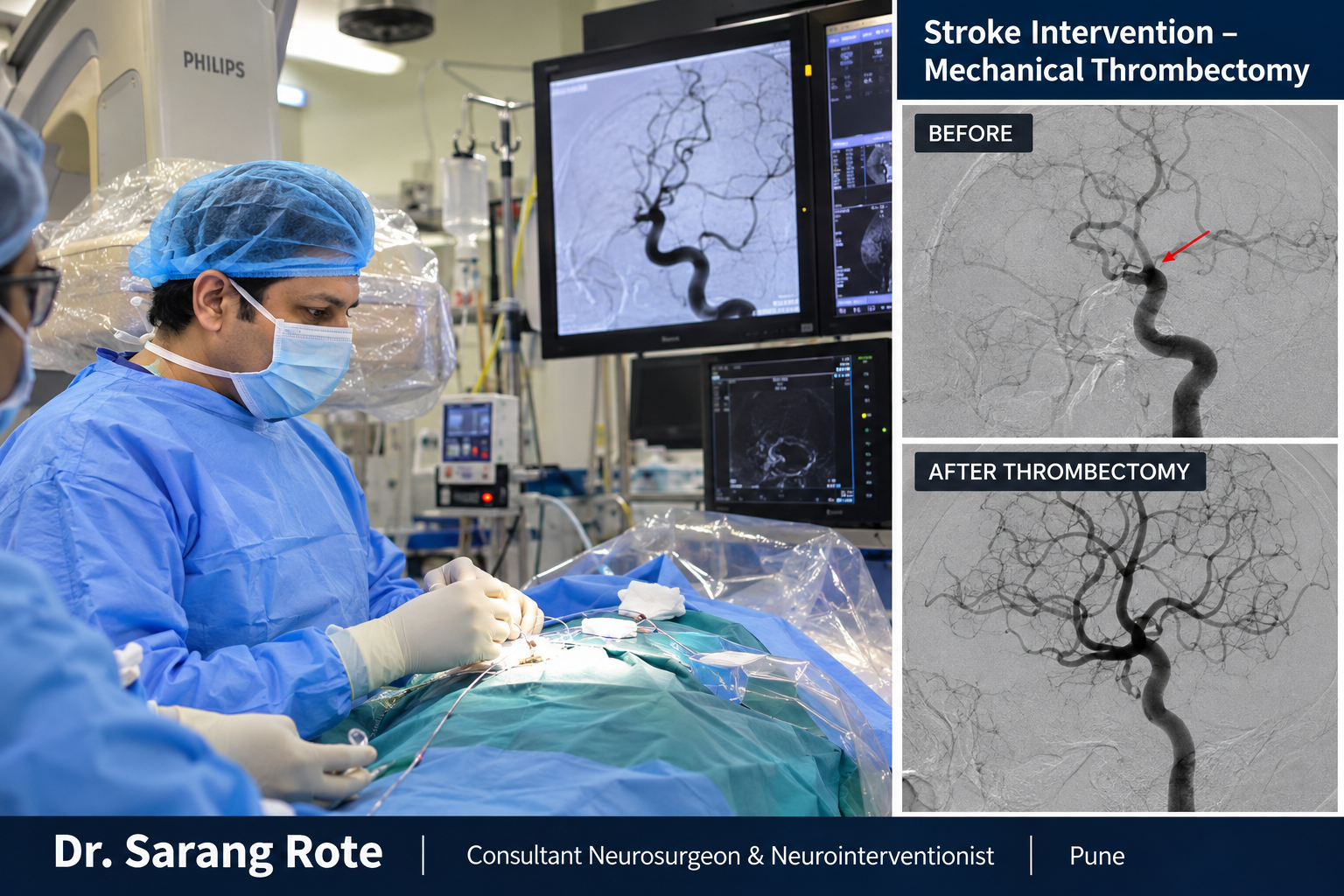 Stroke Treatment and Mechanical Thrombectomy in Pune