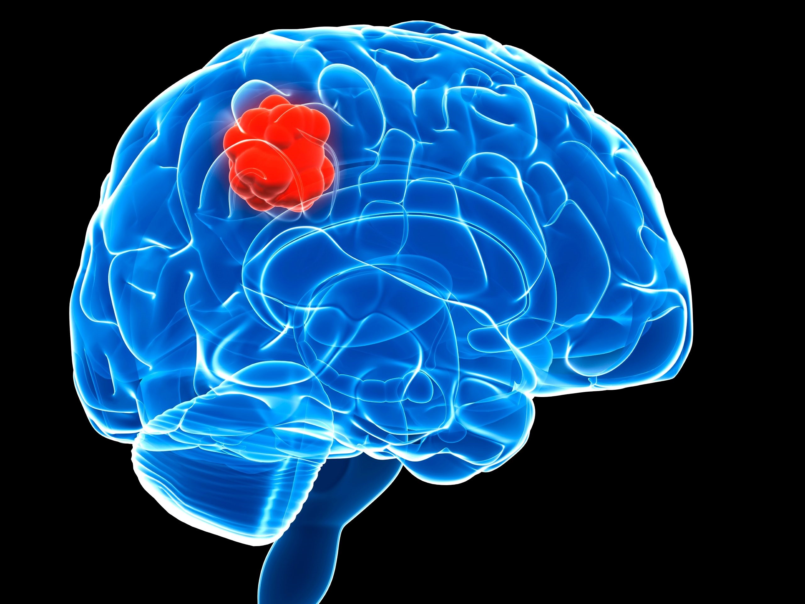 brain-tumors-howtotreatcancer